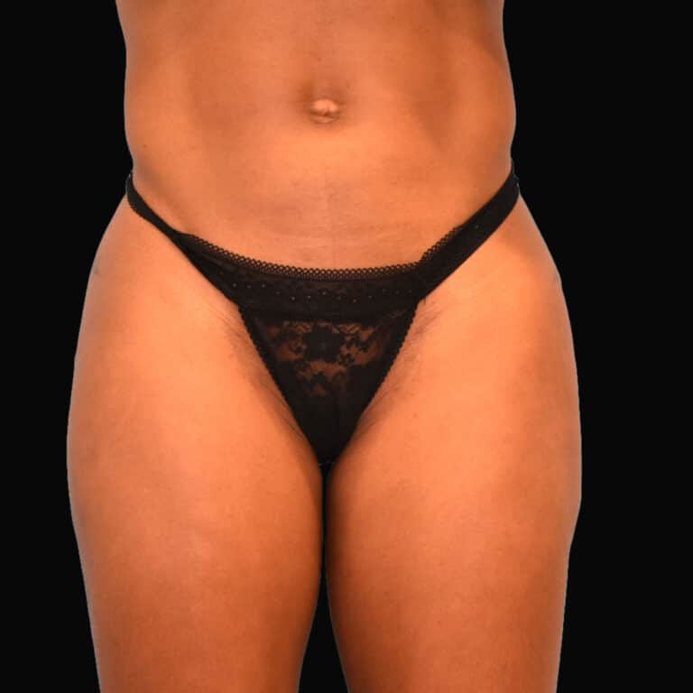 After Image: alloClae Patient #6 - front