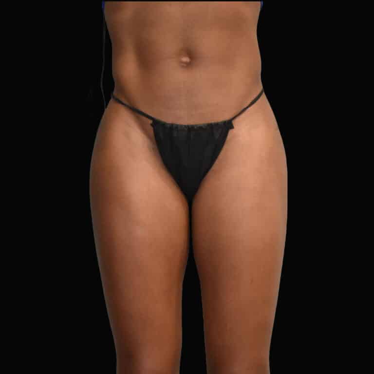Before Image: alloClae Patient #6 - front
