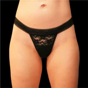 Before Image: alloClae Patient #4
