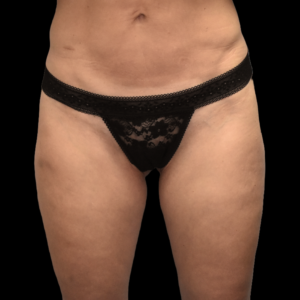 Before Image: alloClae Patient #3