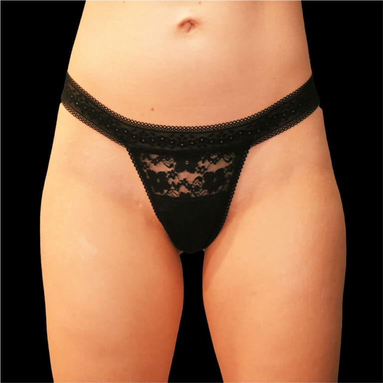 Before Image: alloClae Patient #4 - front