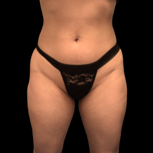 Before Image: alloClae Patient #2