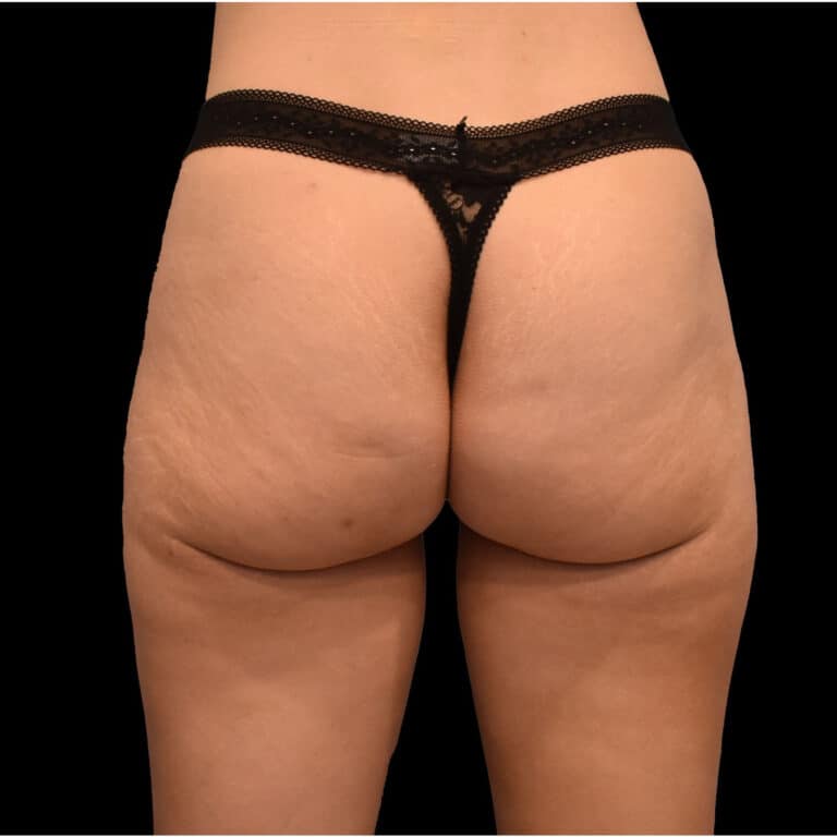 After Image: alloClae Patient #4 - back