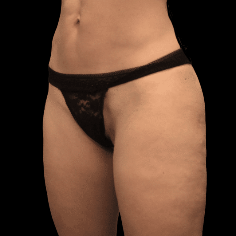 After Image: alloClae Patient #3 - left-front-oblique