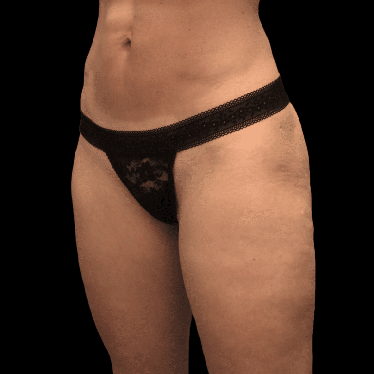 Before Image: alloClae Patient #3 - left-front-oblique