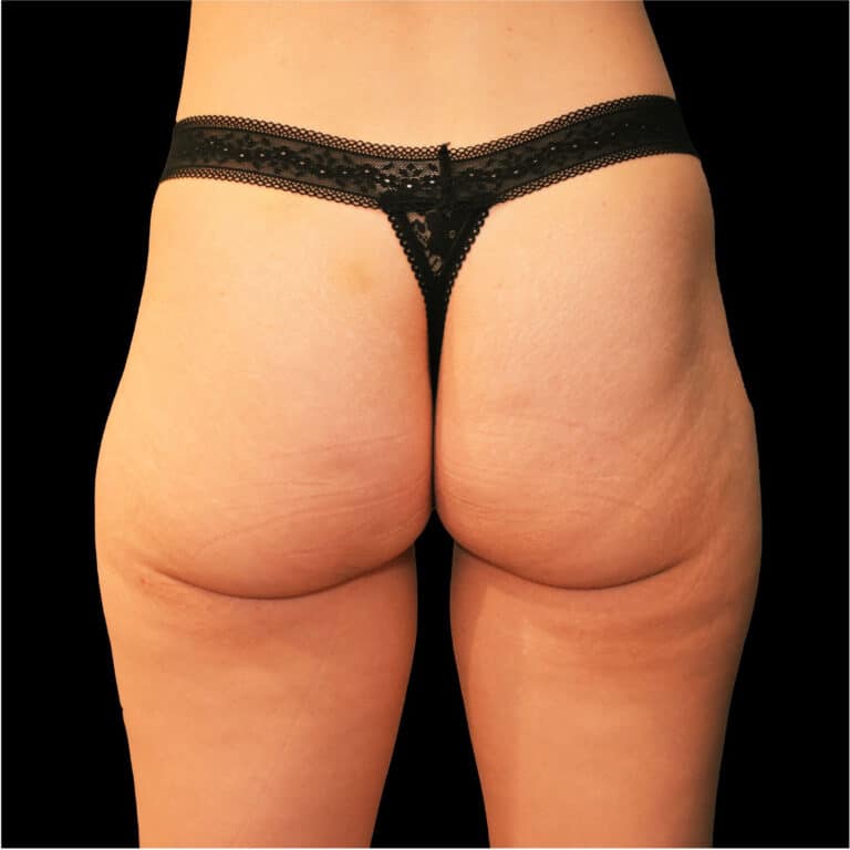 Before Image: alloClae Patient #4 - back