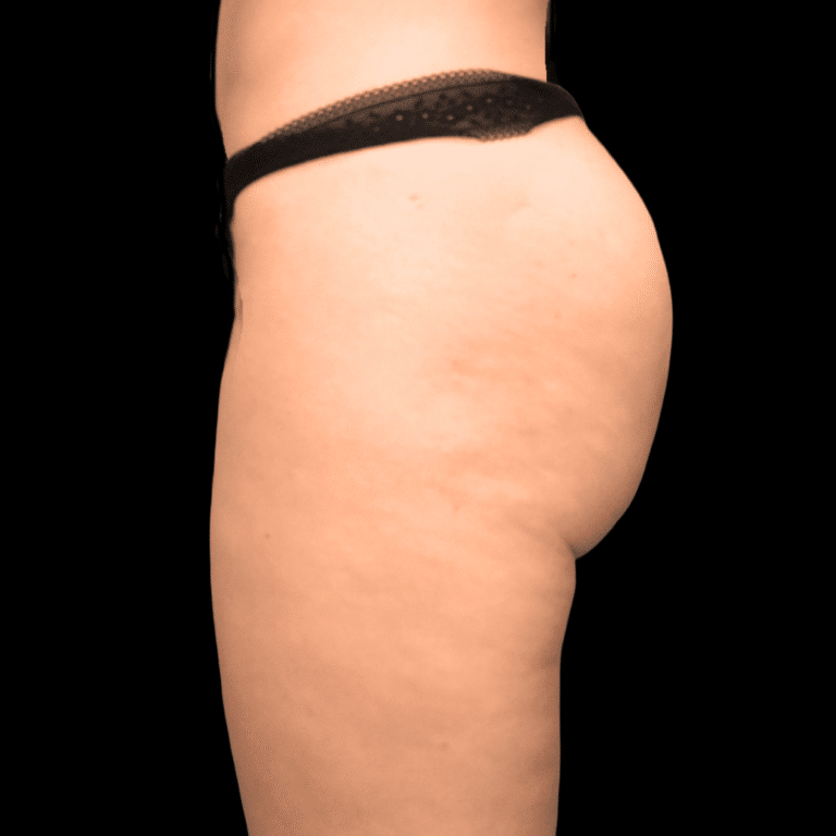 After Image: alloClae Patient #3 - left-side