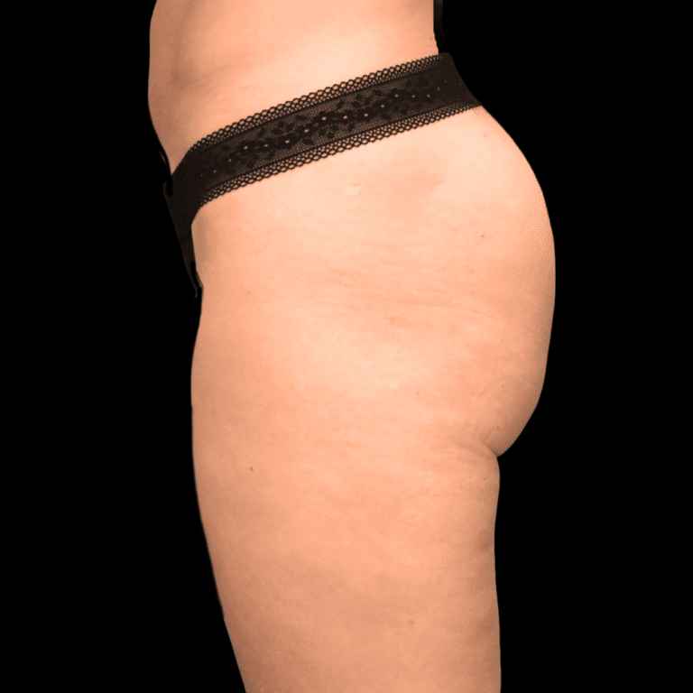 Before Image: alloClae Patient #3 - left-side