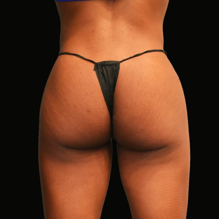 Before Image: alloClae Patient #6 - back