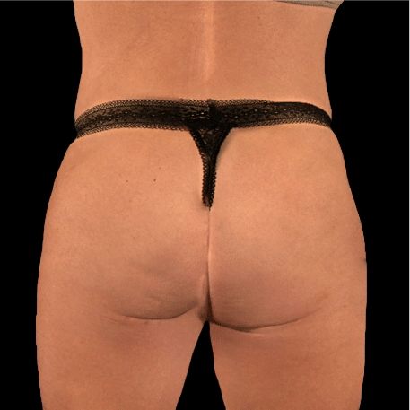 After Image: alloClae Patient #5 - front