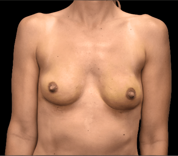 After Image: alloClae Patient #8 - front