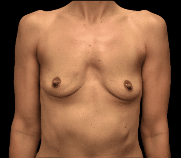 Before Image: alloClae Patient #8 - front