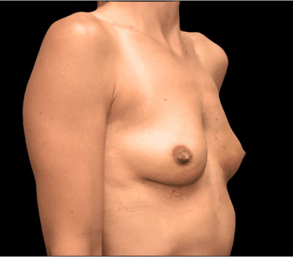 After Image: alloClae Patient #8 - right-front-oblique