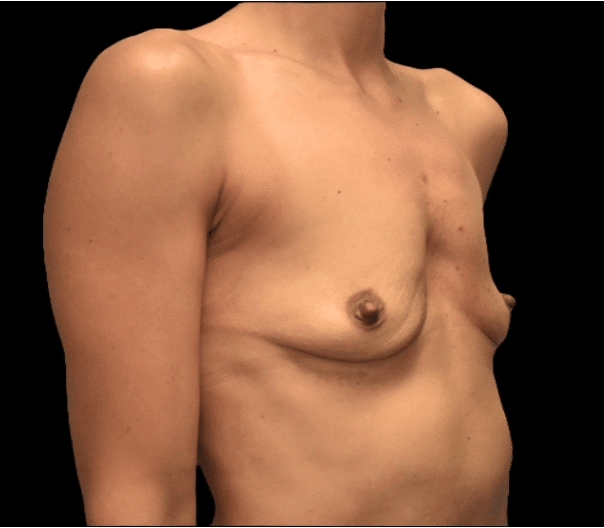Before Image: alloClae Patient #8 - right-front-oblique