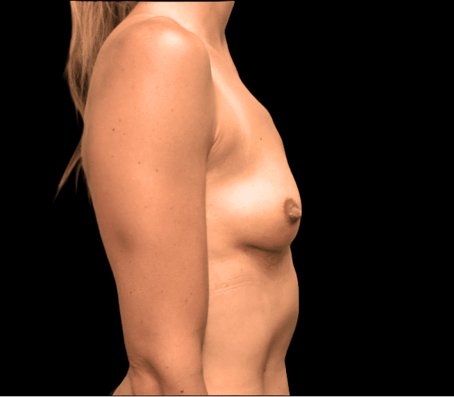 After Image: alloClae Patient #8 - right-side