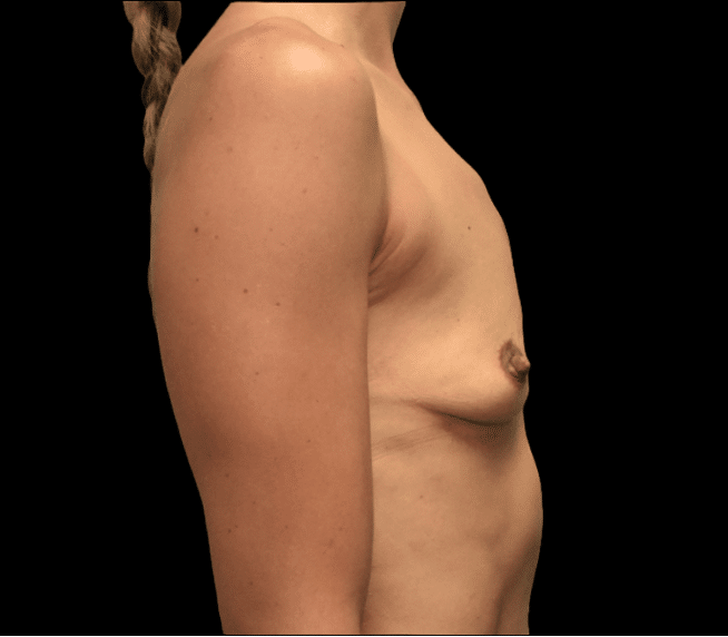 Before Image: alloClae Patient #8 - right-side