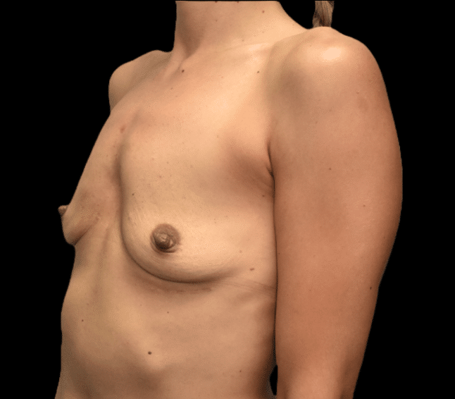 Before Image: alloClae Patient #8 - left-front-oblique
