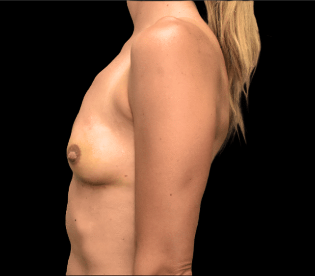 After Image: alloClae Patient #8 - left-side