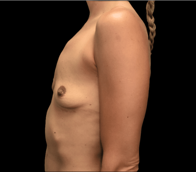 Before Image: alloClae Patient #8 - left-side