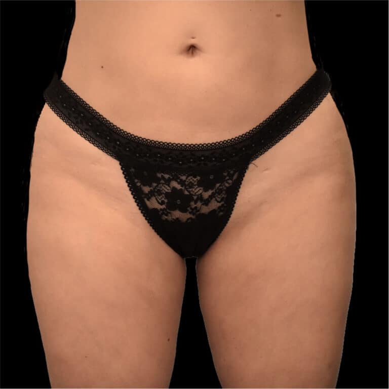 After Image: alloClae Patient #7 - front