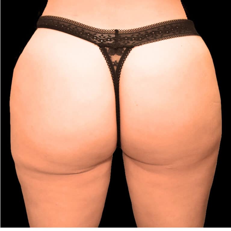 After Image: alloClae Patient #7 - back