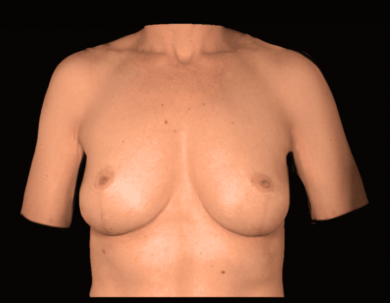 Before Image: alloClae Patient #11 - front