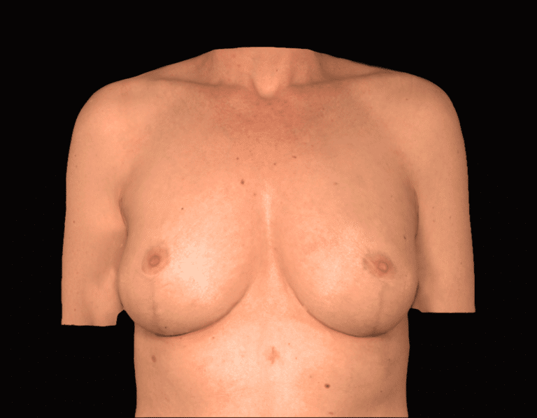 After Image: alloClae Patient #11 - front