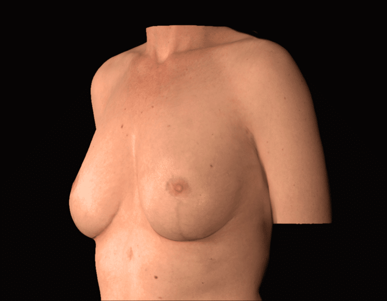 After Image: alloClae Patient #11 - left-front-oblique