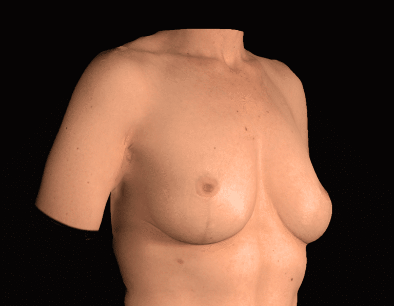 Before Image: alloClae Patient #11 - right-front-oblique