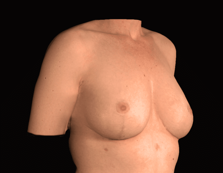 After Image: alloClae Patient #11 - right-front-oblique