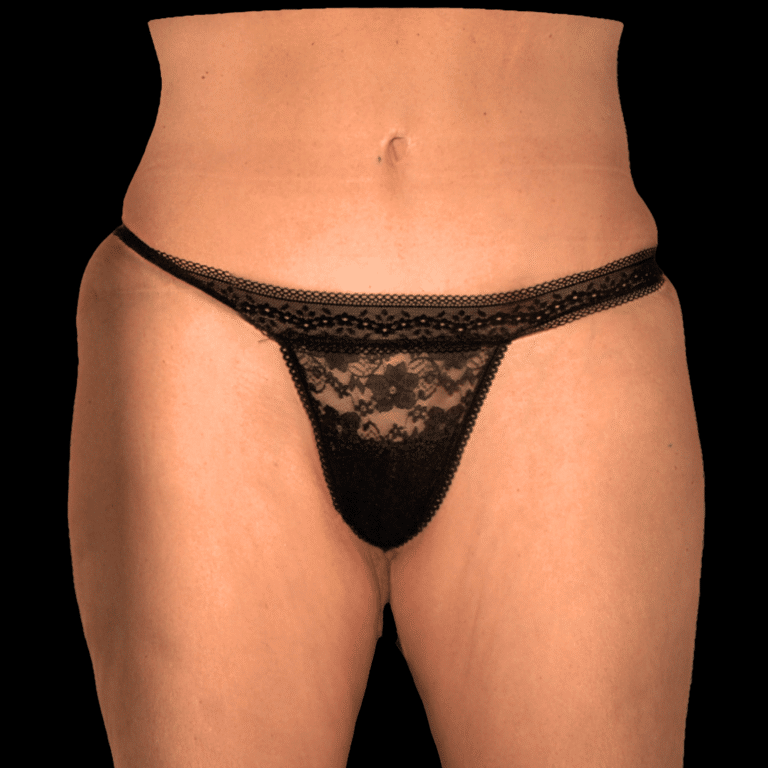 Before Image: alloClae Patient #9 - front