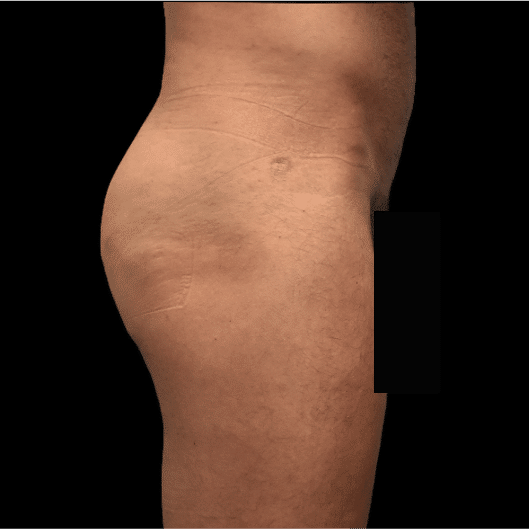 After Image: alloClae Patient #12 - front