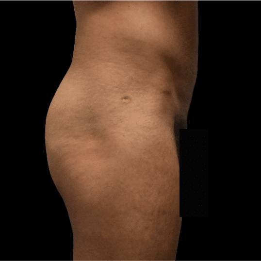 Before Image: alloClae Patient #12 - front