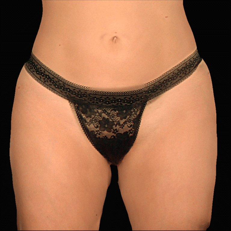 After Image: alloClae Patient #15 - front