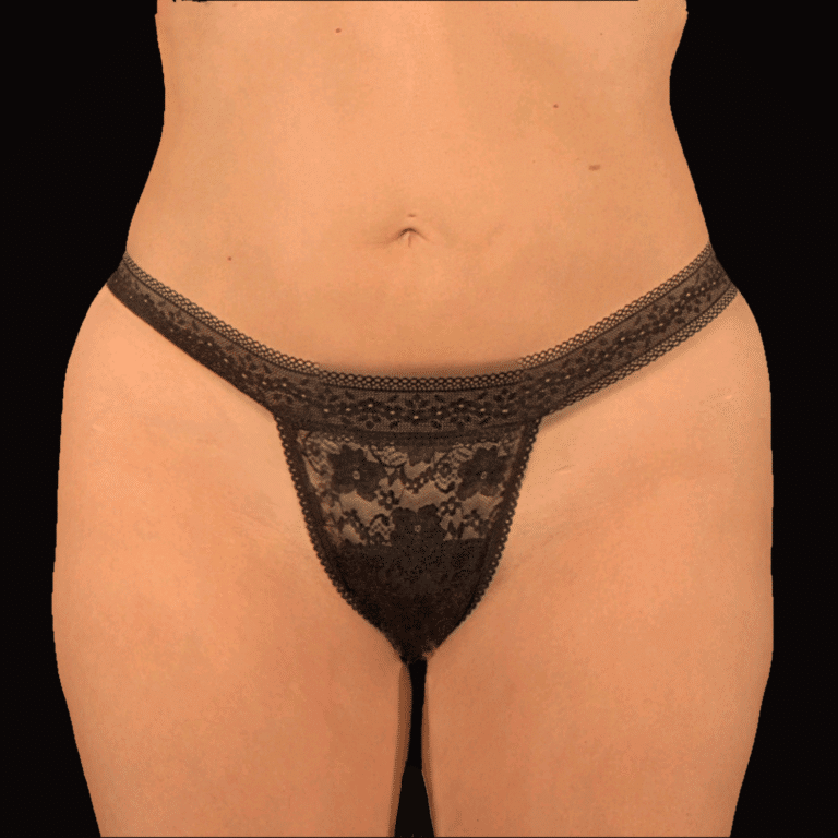 Before Image: alloClae Patient #15 - front