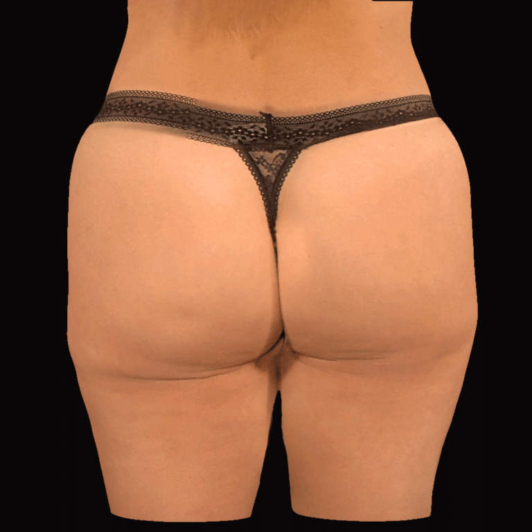 Before Image: alloClae Patient #15 - back