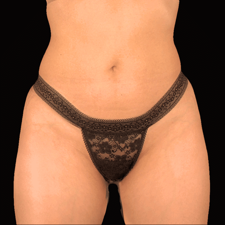 After Image: alloClae Patient #14 - front