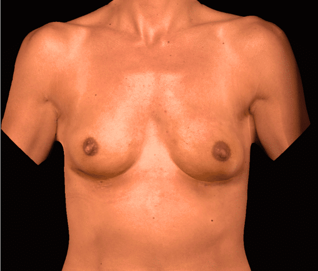 After Image: alloClae Patient #20 - front