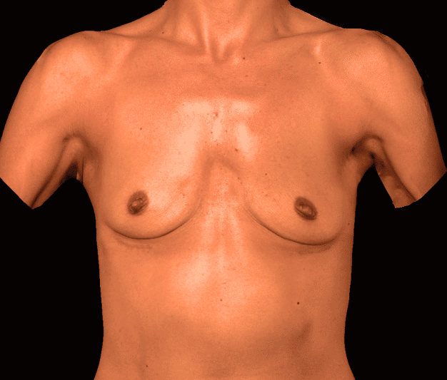 Before Image: alloClae Patient #20 - front