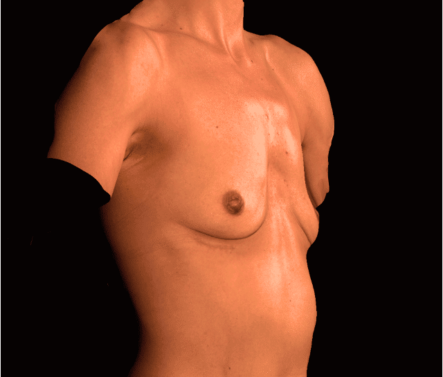 Before Image: alloClae Patient #20 - right-front-oblique