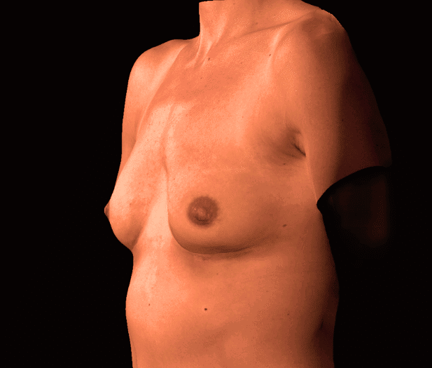 After Image: alloClae Patient #20 - left-front-oblique