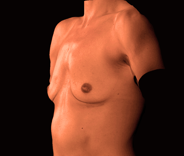 Before Image: alloClae Patient #20 - left-front-oblique