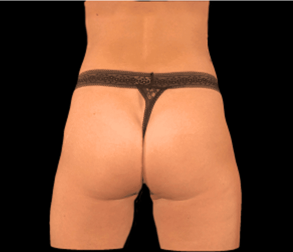 After Image: alloClae Patient #18 - back