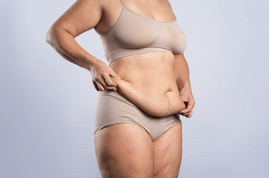 Image of woman with excess skin after losing weight.