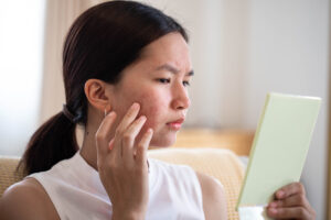 Woman examining acne scarring on her cheek in a mirror