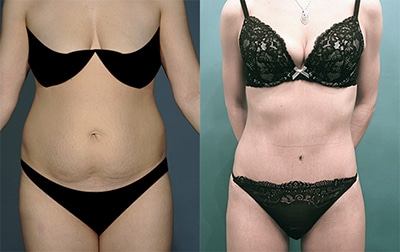 A before and after image set of a woman that underwent a Tummy Tuck in NYC