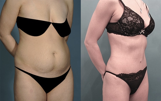 Tummy Tuck in NYC, Abdominoplasty